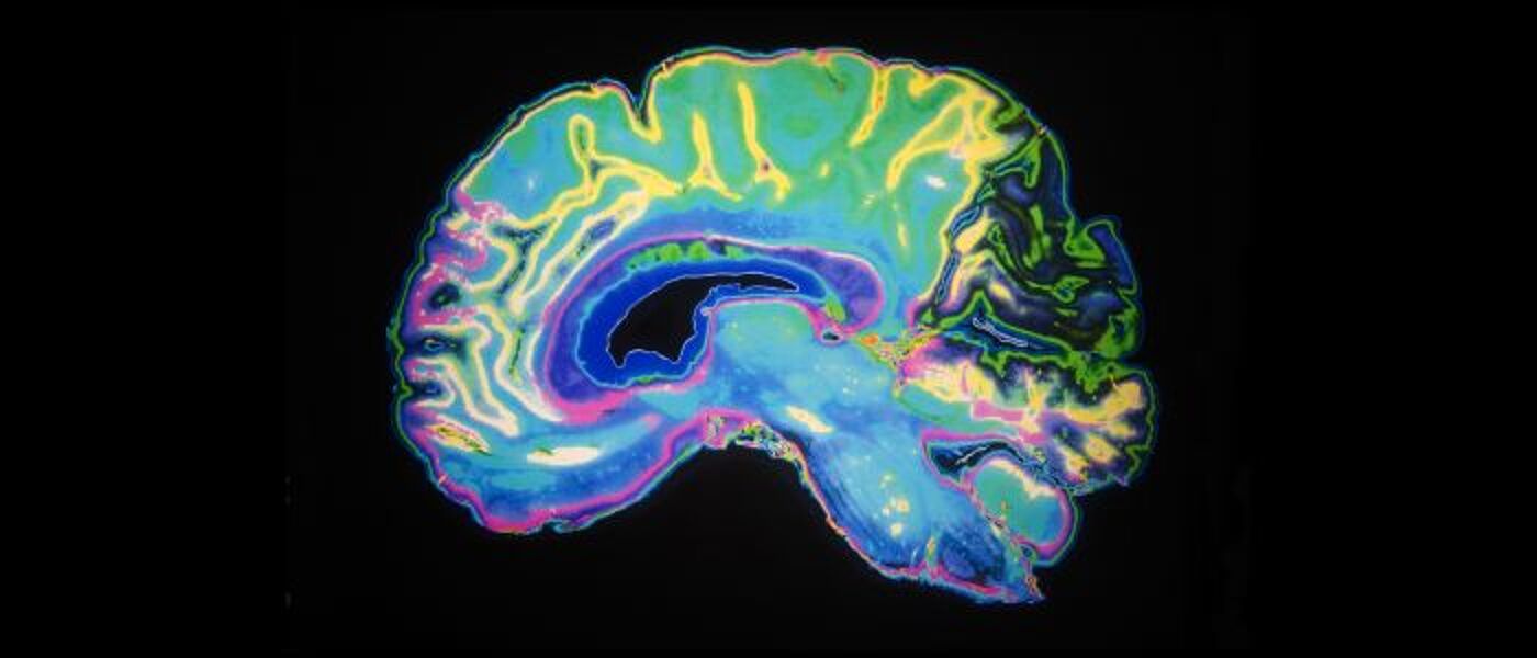 An MRI brain scan