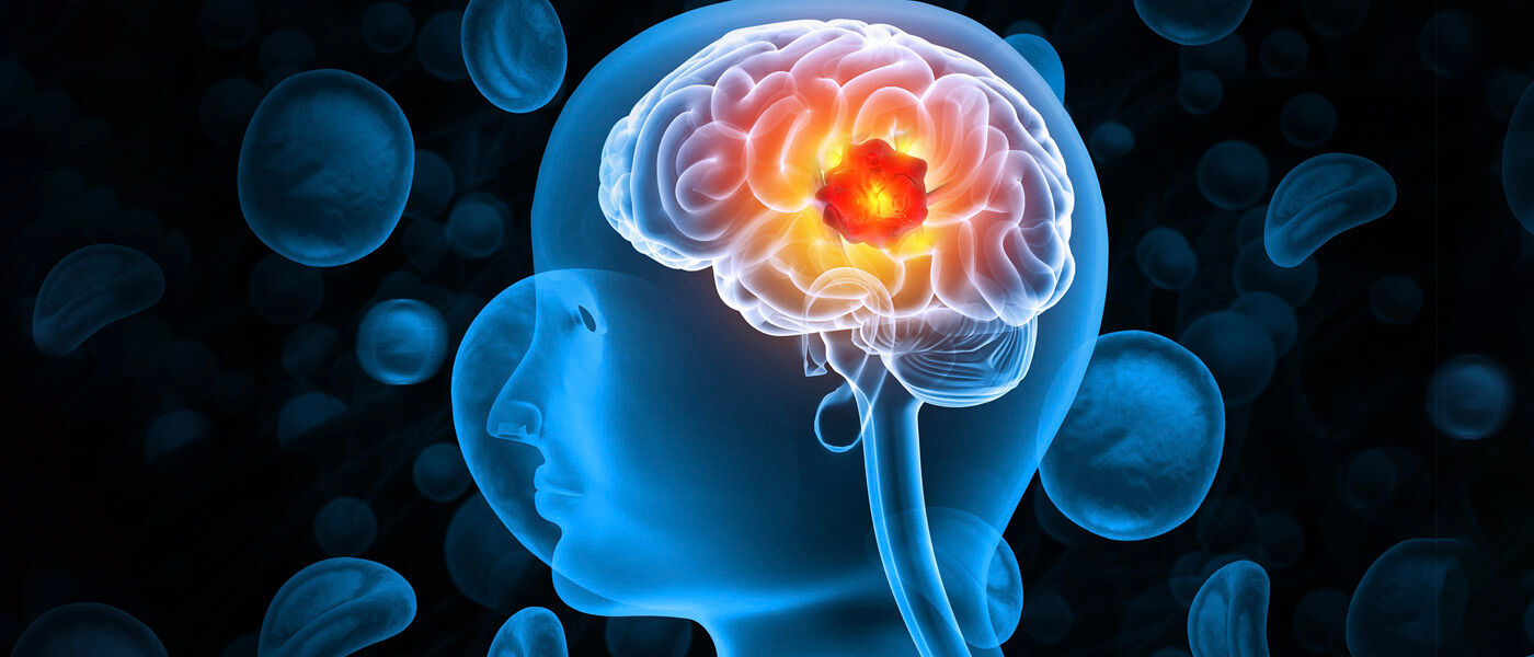 Graphic of a brain tumour